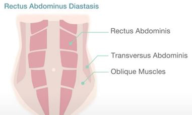 An anatomical drawing showing rectus abdominis, transversus abdominis and oblique muscles at the front of the abdomen